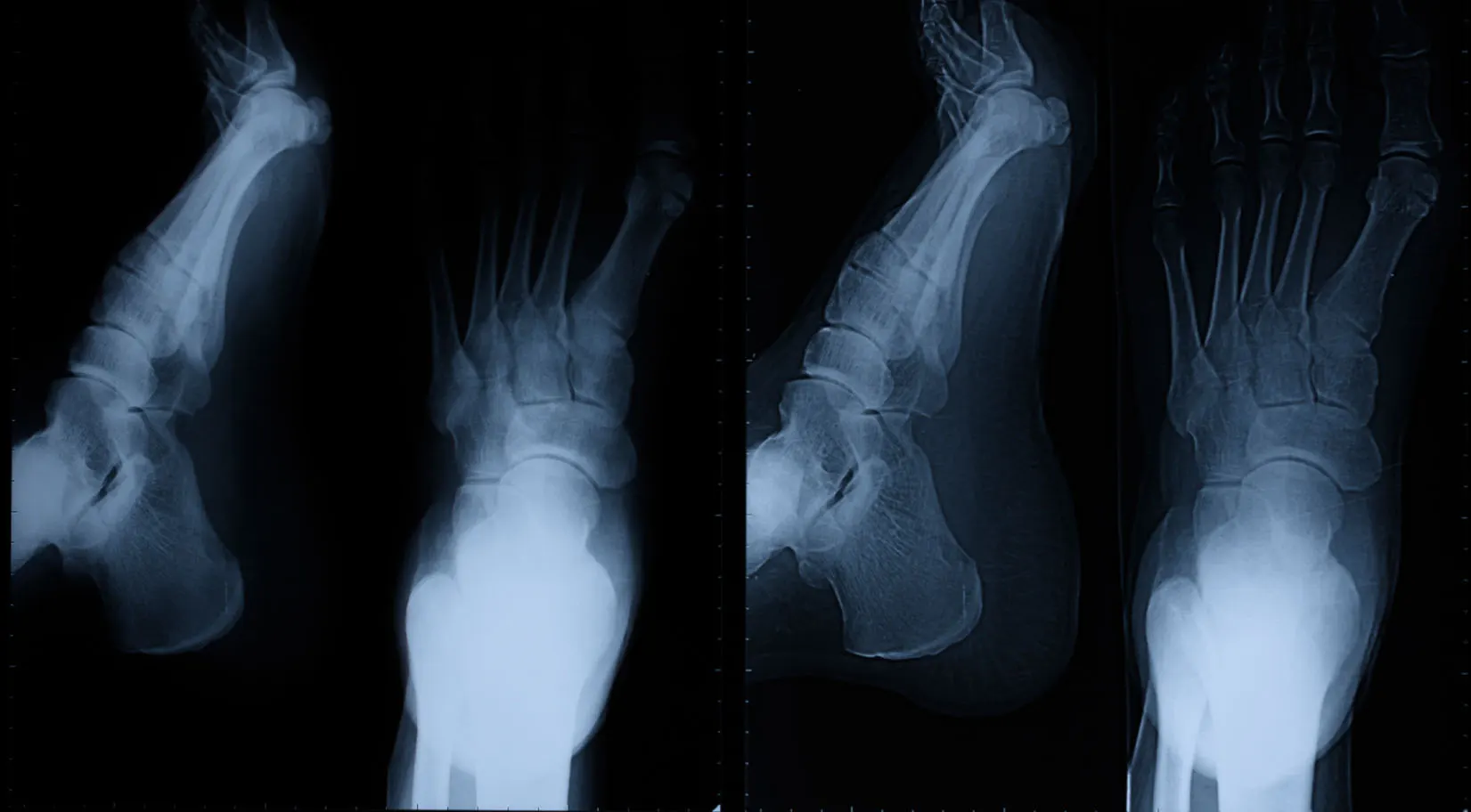 Stress Fractures