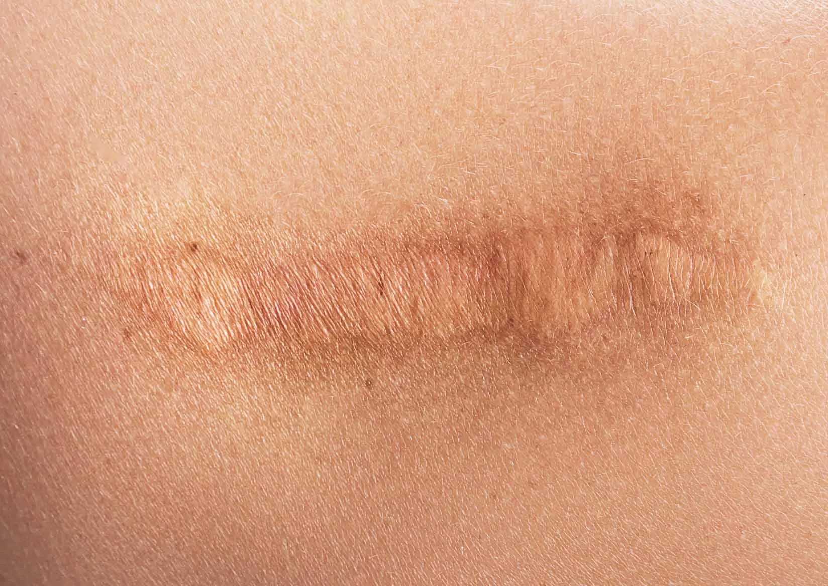 What is a Scar?